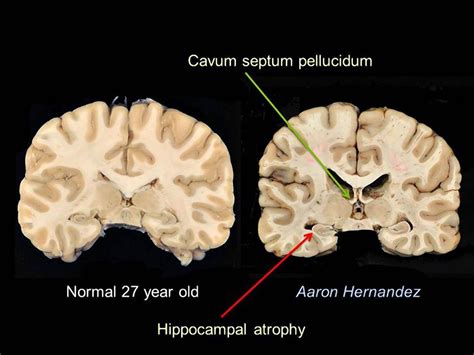 aaron hernandez brain scan