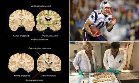 aaron hernandez brain study results