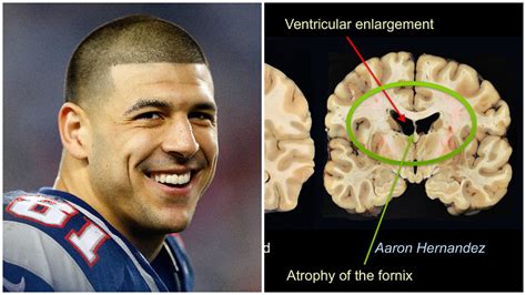 aaron hernandez cte symptoms