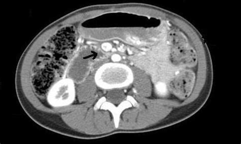 Graftversushost disease. Nonenhanced CT scan shows barium within the