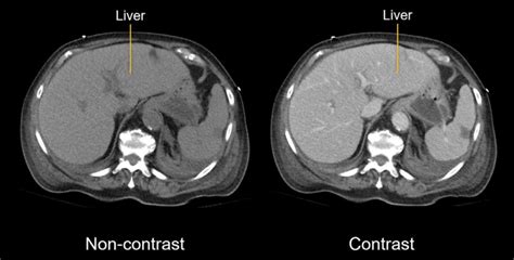 Understanding the Abdominal CT Scan with Contrast: What to Expect and Why It's Done