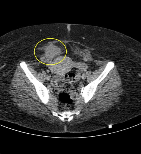 abdominal wall endometrioma radiology