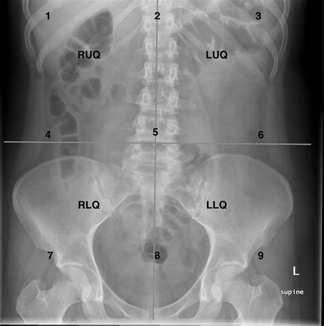 Understanding Your Abdominal X-Ray: What the Images Reveal About Your Health