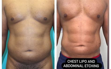 Abdominal Etching Before and After Photos