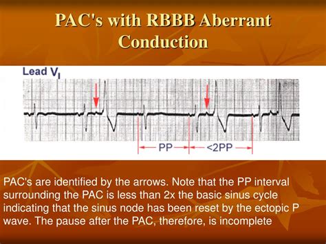 aberrant beats vs pvc