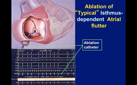 ablation flutter atrial commun