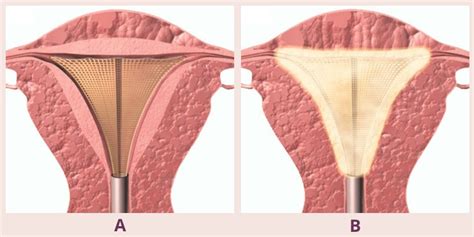 Endometriosis Relief: How Ablation for Periods Can Transform Your Life