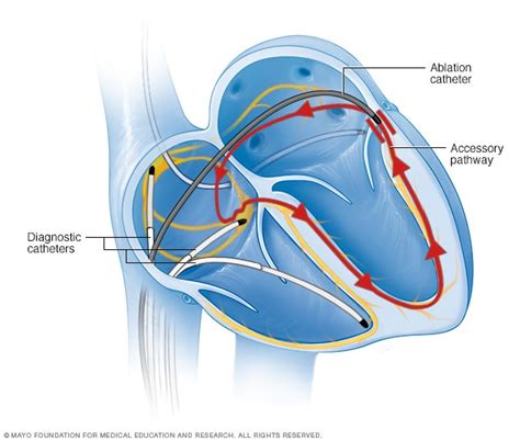 Ablation for SVT: A Life-Changing Treatment for Fast Heart Rate