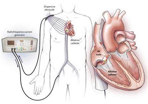 Ablation Heart Surgery: Minimally Invasive Treatment for Heart Rhythm