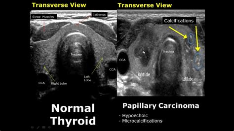 abnormal thyroid ultrasound images pictures