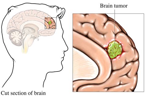 about brain cancer