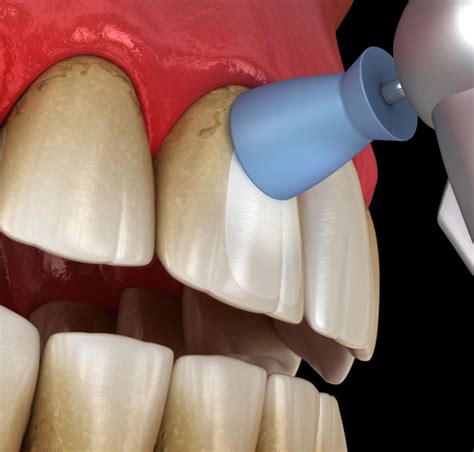 Abrasive Paste Teeth