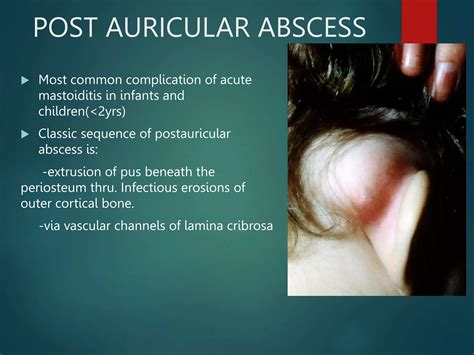 Abscess Behind Ear