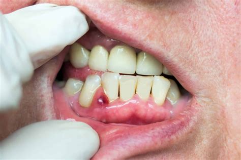 Gum Abscess: Warning Signs and Effective Treatment Options