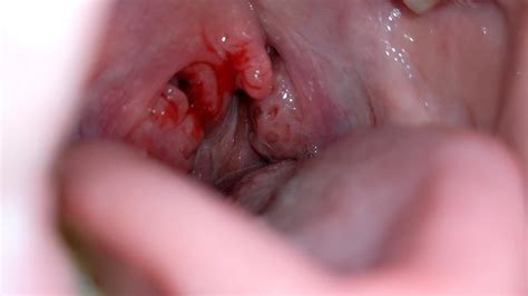 What You Need to Know About an Abscess Inside Your Throat: Causes, Symptoms, and Treatment Options