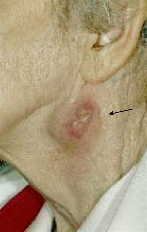 Abscess Lymph Node Neck