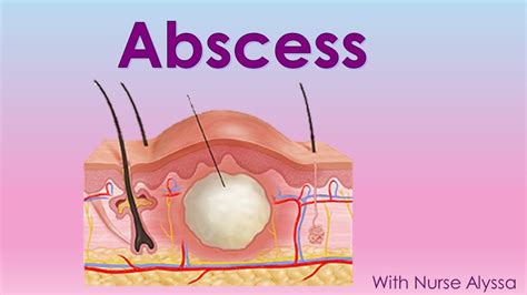 Abscess Medical Terminology