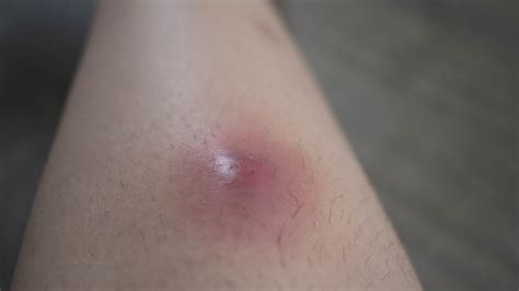 Warning: Signs and Symptoms of an Abscess on Leg