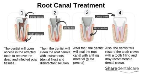 Abscess Tooth After Root Canal