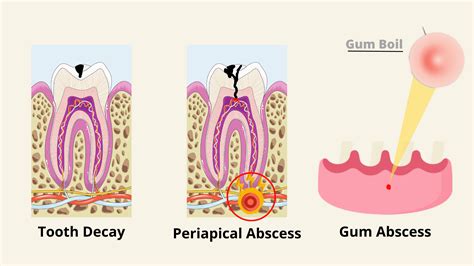Abscess Tooth Beginning