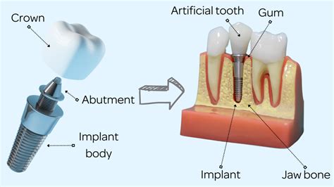 Abutment Dentistry