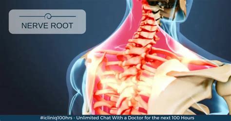 abutment of the nerve root