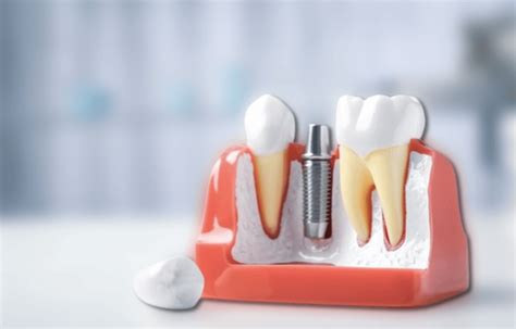 Abutment Replacement