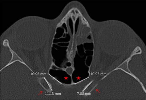 Accessory Optic Canal
