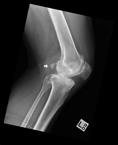 accessory ossicle knee radiology