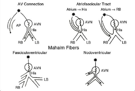 Accessory Pathway Types
