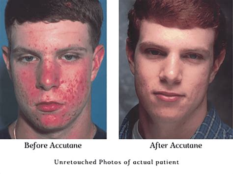 accutane bone color