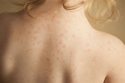 acetaminophen allergy rash