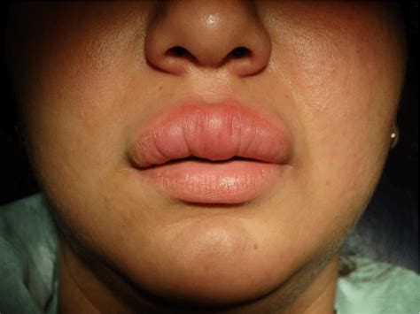 Acetaminophen Lip Swelling
