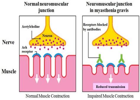 acetylcholine receptor antibody positive