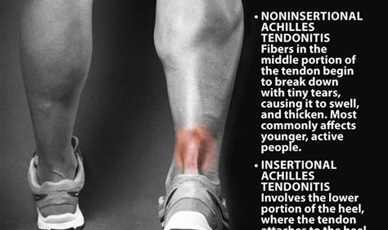 Achilles Pain After Ankle Sprain
