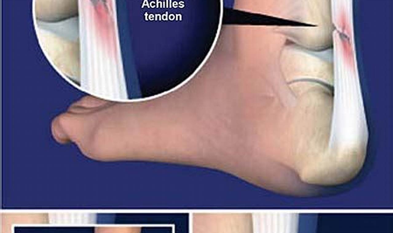 Achilles Tendon Debridement and Removal of Bone Spur: Recovery Time