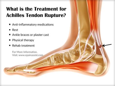 achilles tendon rupture treatment