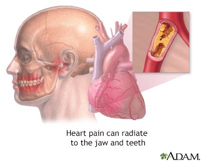 Aching Jaw Heart Attack: Hidden Symptoms You Should Know