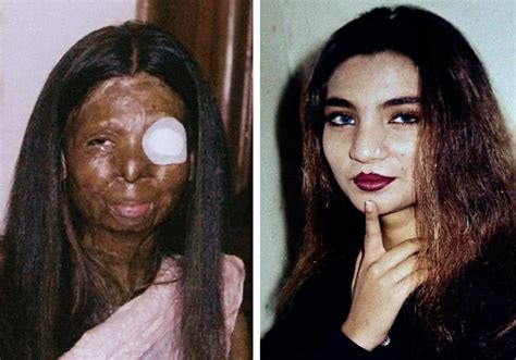 Acid Attack Face Before And After