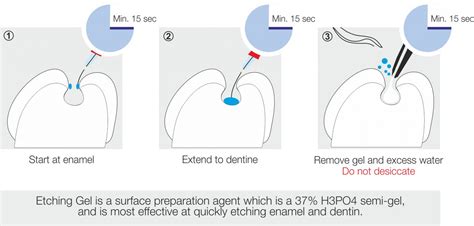 Acid Etching In Dentistry Time