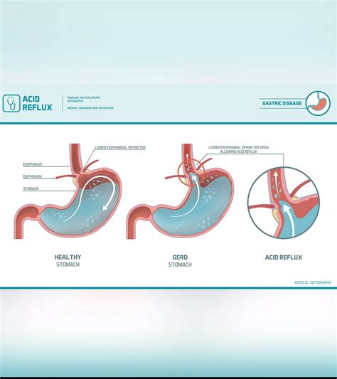 Acid Reflux Eye Problems