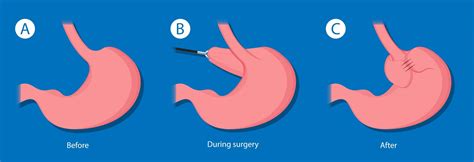 Acid Reflux Surgery: Is It Right for You?