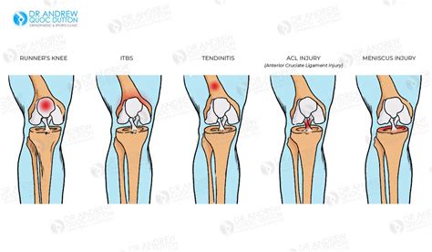 acl and meniscus surgery time