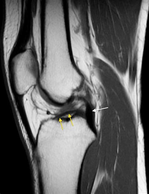 acl complete tear mri