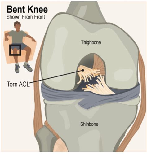acl grade 3 tear treatment without surgery