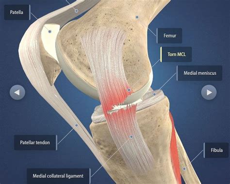 acl mcl and pcl tear