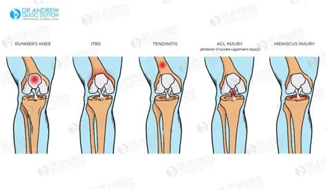 acl meniscus surgery