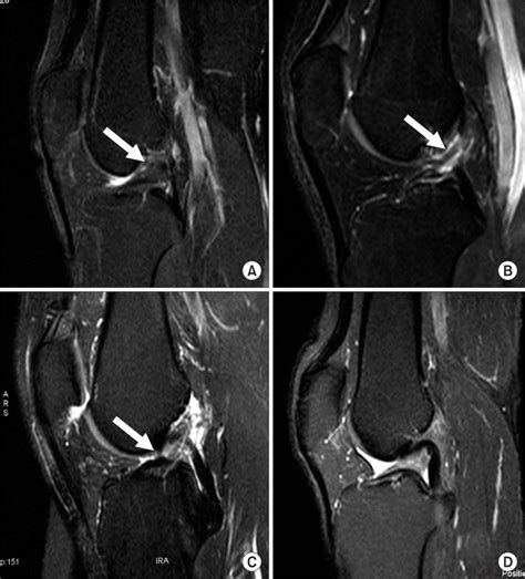 acl tear mri grading