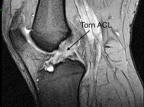 acl tear radiology assistant