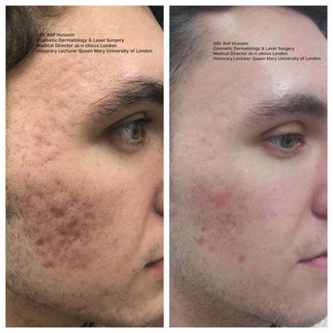 Laser Skin Resurfacing for Acne Scars Efficacy, Before & Afters, Cost